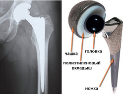 Эндопротезирование тазобедренного сустава