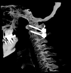 Нейрохирурги «Больницы скорой медицинской помощи» освоили методику хирургического лечения пациентов с повреждением верхнешейного отдела позвоночника